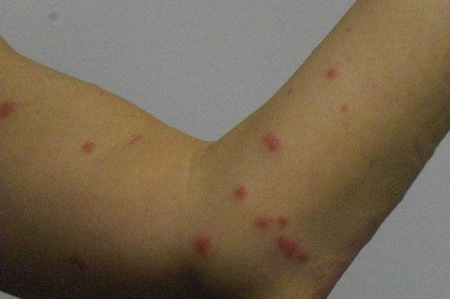 scabies arm