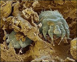 scabies-mites-borrow